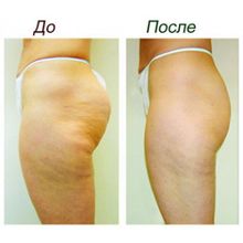 Аппарат для кавитации, радиолифтинга, ультразвуковой BS-08